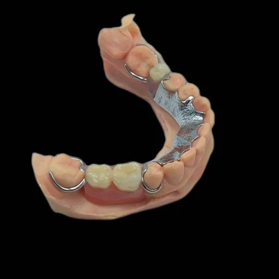 CoCr-metalen raamwerk met acrylprothese