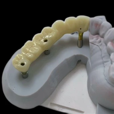 Zirkonia-implantaatbrug met titanium abutment
